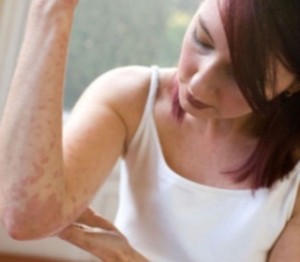 Eczema – What Is It, What Causes It, and How to Treat It
